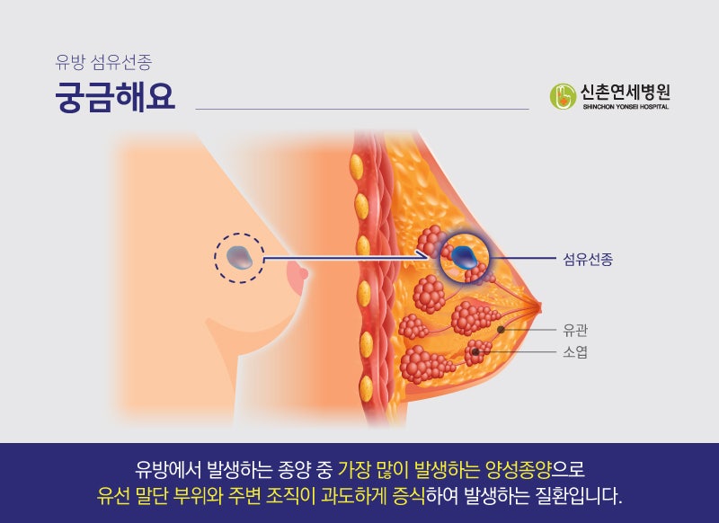 유방섬유선종 멍울이 만져진다면?