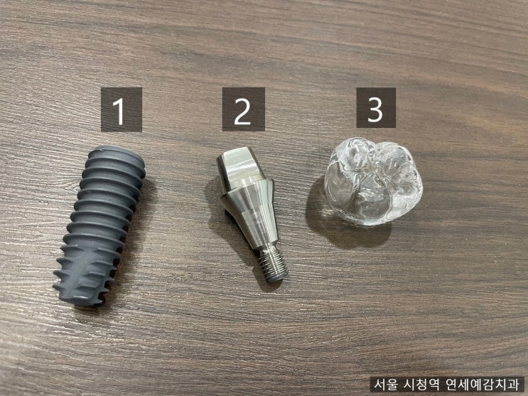  [서울시청역치과] 다른 치과에서 오래전에 한 임플란트가 흔들려요 →재수술 케이스