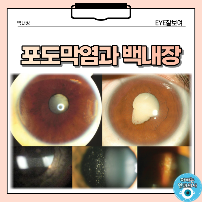  포도막염과 백내장의 관계