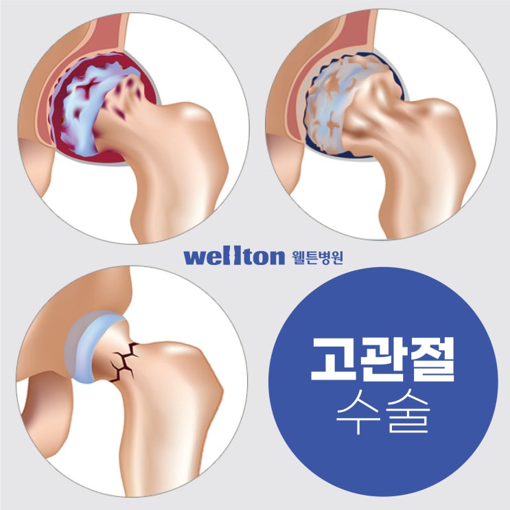  고관절수술병원 손상된 고관절을 안전하게 대체