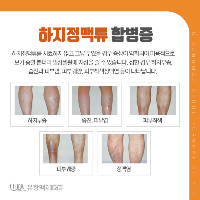 강변역하지정맥류 증상 치료를 도와주는 병원으로 내원을