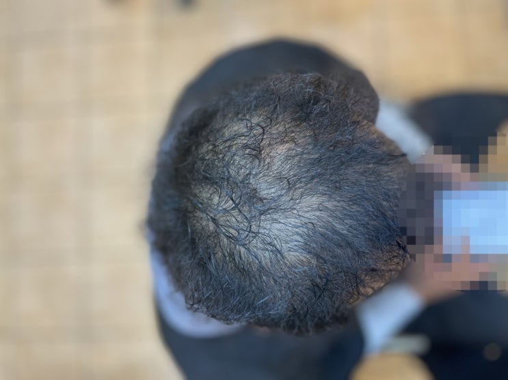  증모술 아니구요 모발이식 보다 더편한 탈모커버펌입니다 부산 원탑 탈모관리전문미용실 르네시떼헤어샵 /창원마산거제송도밀양양산울산대구진주경주사천통영제주김해주례감전당감연제동래명륜장전학장