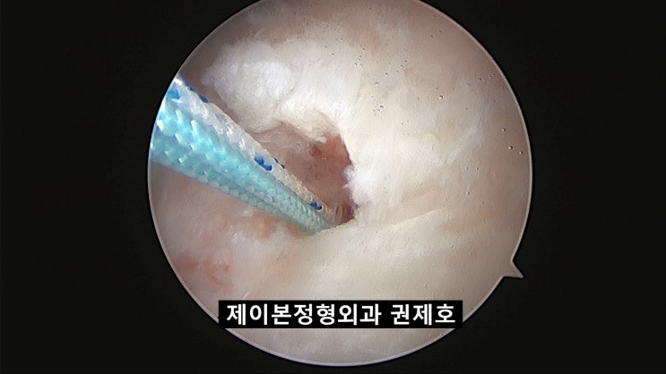  어깨회전근개파열 strong 건강한 어깨 되는 방법