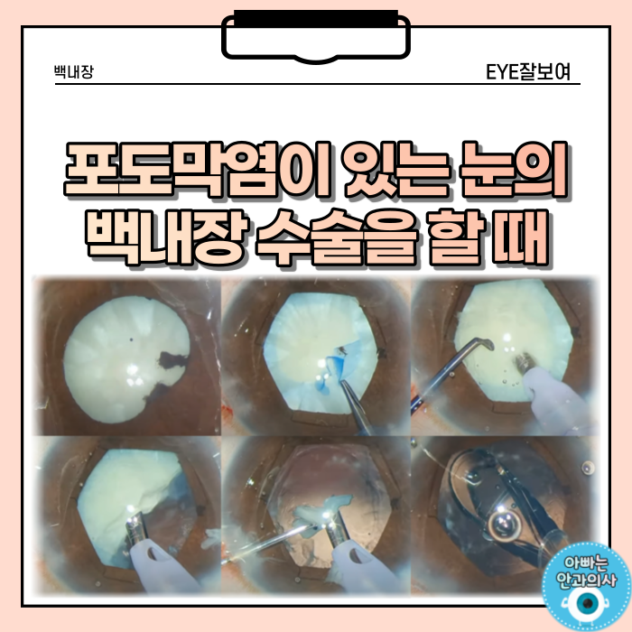 포도막염이 있는 백내장의 수술