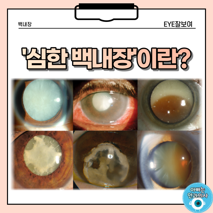 심한 백내장을 수술 하기 전에