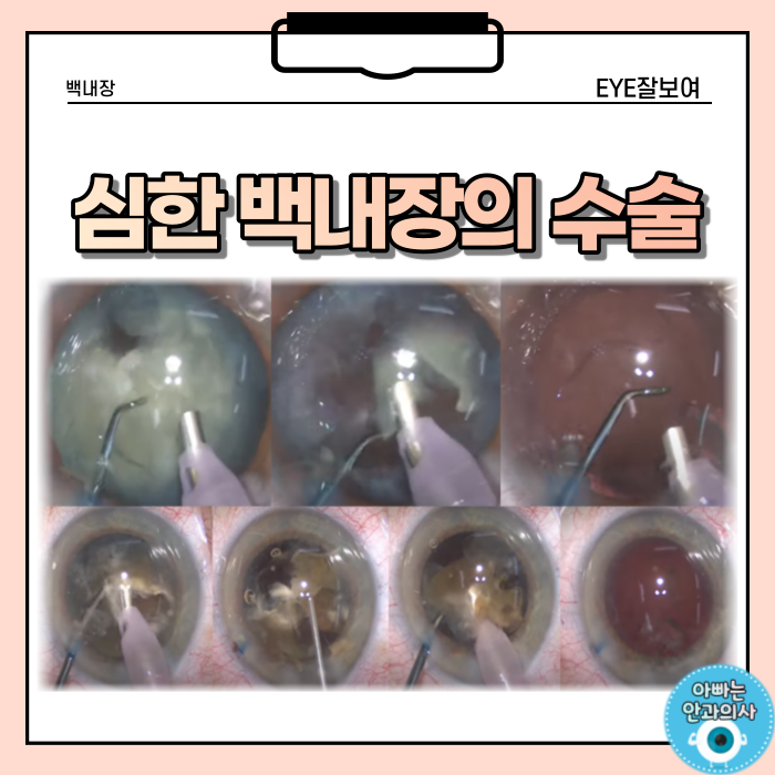  심한 백내장의 수술 (2) - 합병증을 줄이기 위한 방법들