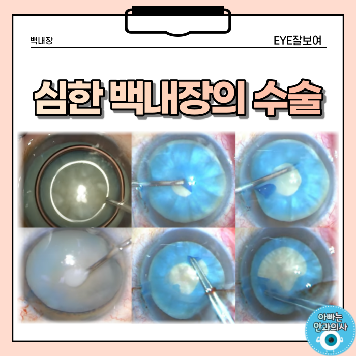  심한 백내장의 수술 (1) - 보다 안전한 수정체낭원형절개(CCC)를 위해서