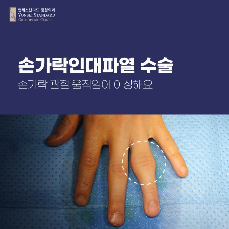 손가락인대파열 손가락탈골 어떻게 수술해야 할까요 : 네이버 블로그