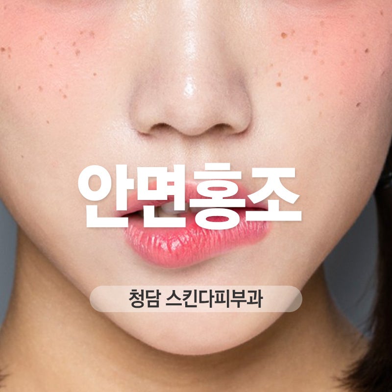 안면홍조 원인에 따른 레이저 2
