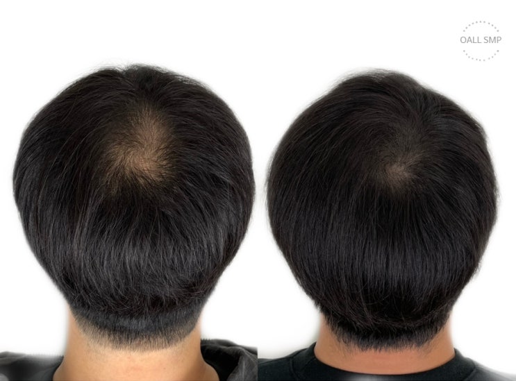  [OALL Scalp studio] 남성 정수리 탈모 보완 smp 시술