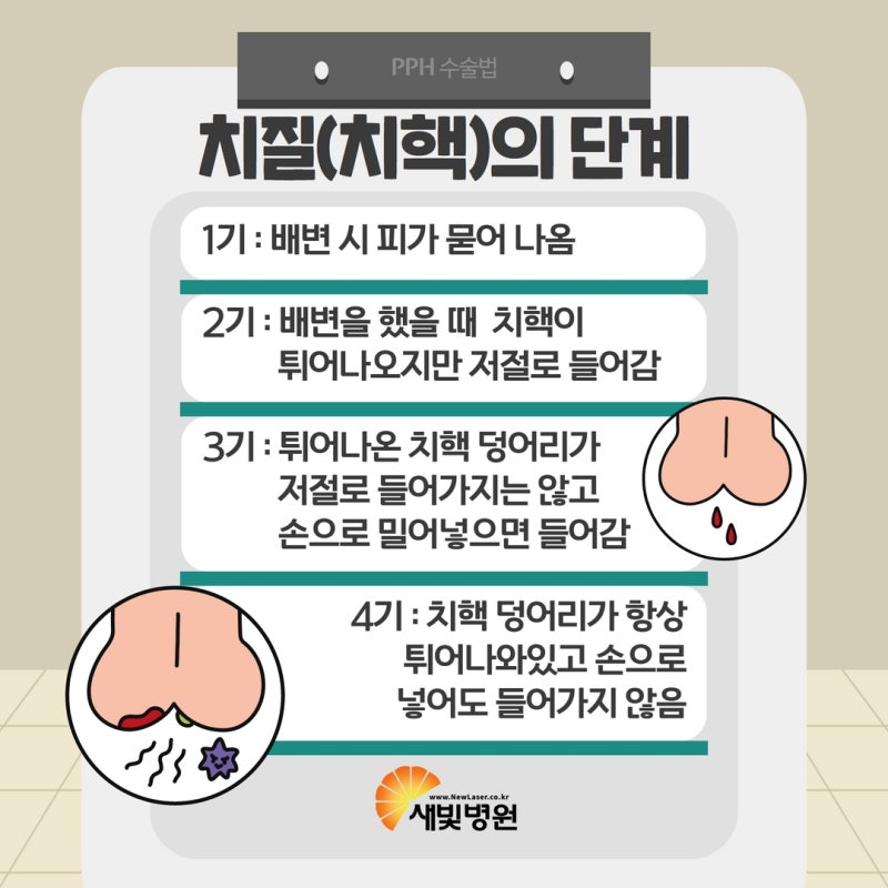 청주항문외과 치질수술 상담부터 3