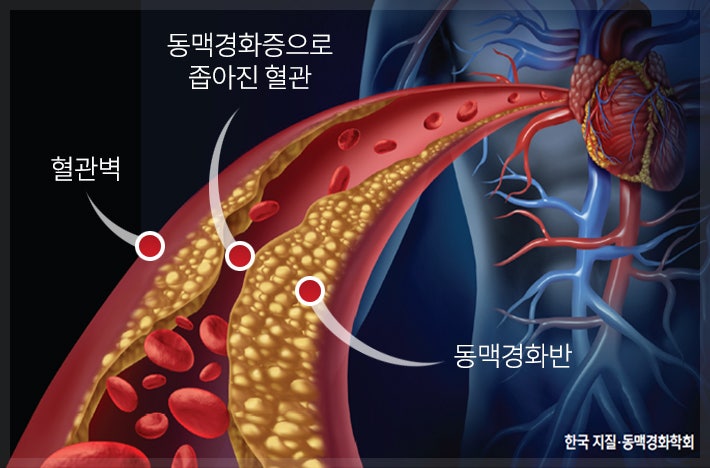 탈라킬레이션 혈관 청소로 동맥경화 고지혈증 치료 및 예방 2