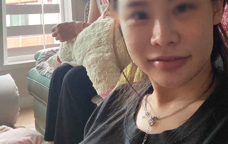 콧볼축소수술 재수술 후기 1년차 8