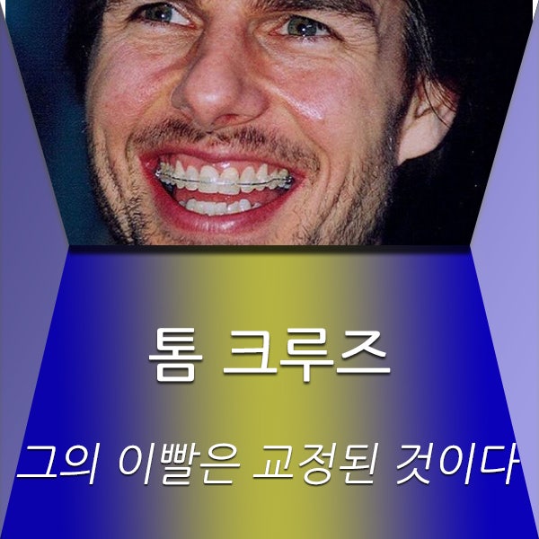  톰 크루즈 그의 치아는 교정된 것이다.