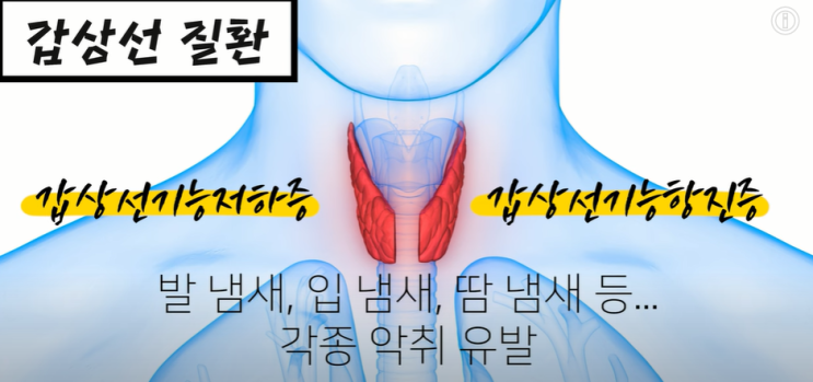 여름철 악취를 유발하는 질환 갑상선염 편도결석 여름철 악취를 유발하는 질환 갑상선염 편도결석