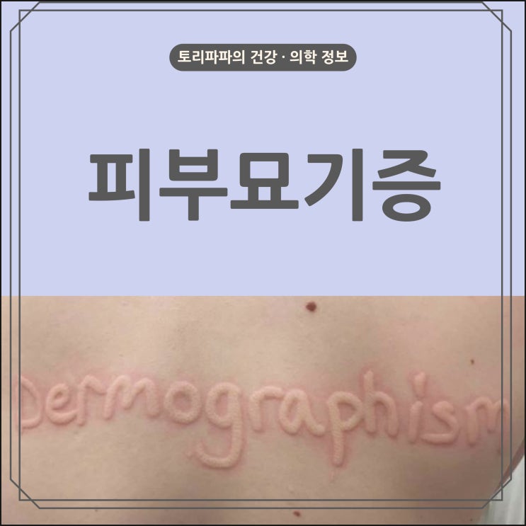  피부묘기증 피부기묘증 종류 원인 치료