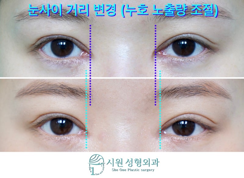 204 앞트임 재건술은 앞트임 수술의 부작용(움푹 들어간 흉터, 몽고주름, 눈물 과다노출)을 개선합니다.시원성형외과 204 앞트임 재건술은 앞트임 수술의 부작용(움푹 들어간 흉터, 몽고주름, 눈물 과다노출)을 개선합니다.시원성형외과