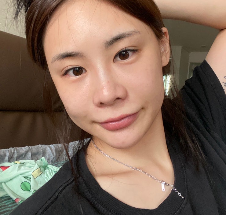 콧볼축소수술 재수술 후기 1년차 7