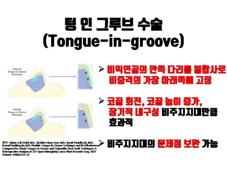  비주지지대 없이 코수술 후 코끝 처짐을 예방할 수 있는 코성형!!!