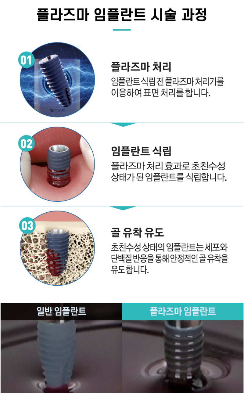 메가젠플라즈마 X 임플란트 장비 도입 안내 : 네이버 블로그