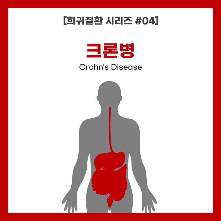  [희귀질환 시리즈 #04] 크론병