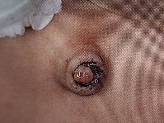  신생아 배꼽 육아종 원인과 치료