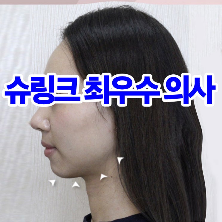  강남 인모드비용 및 슈링크 유니버스 300샷 가격 울트라 부스터 주기 간격 부작용