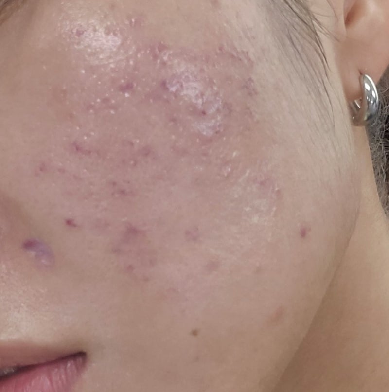 여드름흉터 없애는 법! 내돈내산