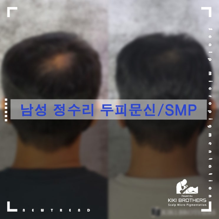  정수리탈모!! 지켜만 보지 마시고 커버하세요. 탈모커버 SMP전문점 키키브라더스 노원