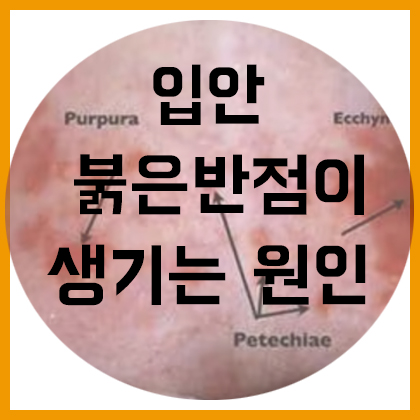  [목] 입안에 붉은 반점이 생기는 이유는?(점상출혈, 자반증, 반상출혈)