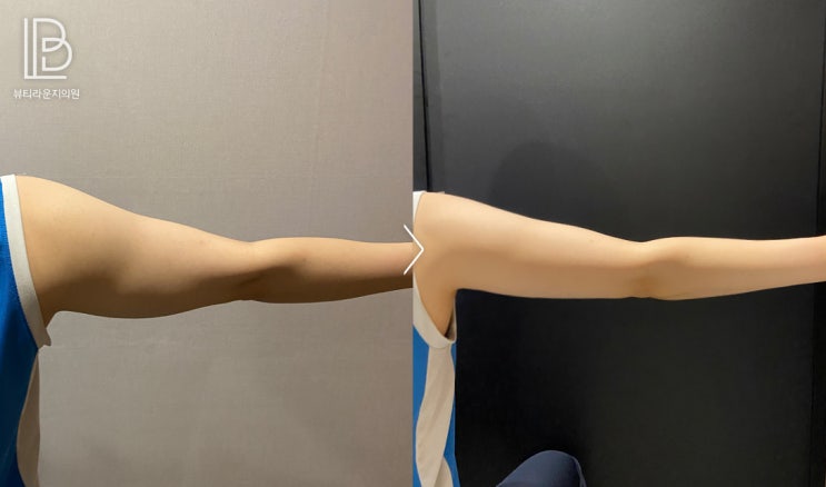  뷰티라운지잠실 울핏으로 수술 없이 지흡효과