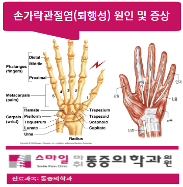  [일산손가락관절염병원]  손가락 퇴행성관절염 원인 및 증상