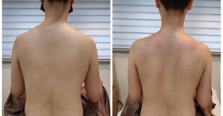  대구 범어네거리 피부관리 김현정에스테틱 승모근 관리 받았어요