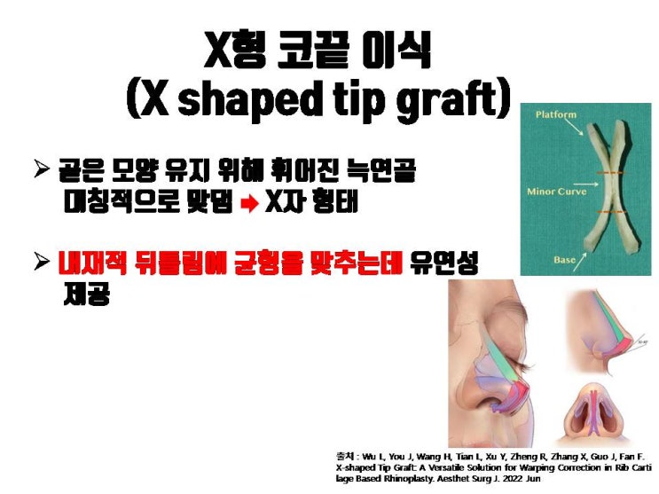  늑연골 코수술의 휘어짐, 뒤틀림 증상을 해결할 수 있는 수술 방법!!