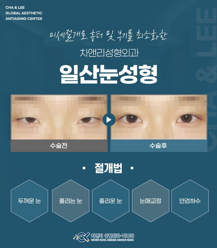  일산눈성형 자연스러운 라인으로