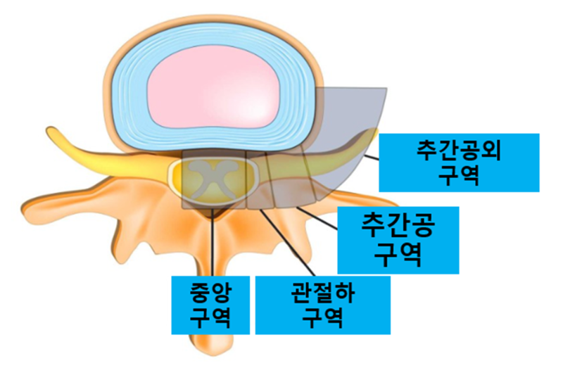 우측 엉치 하지 방사통으로 오신 분 치료 증례 : 네이버 블로그