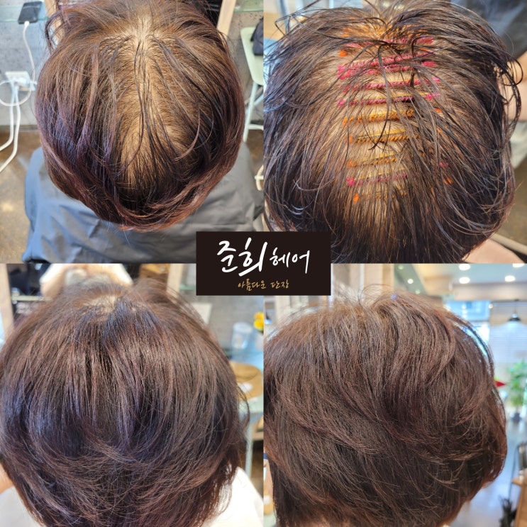  숏컷 +링거펌(정수리 탈모)  김포 장기동 미용실 준희헤어