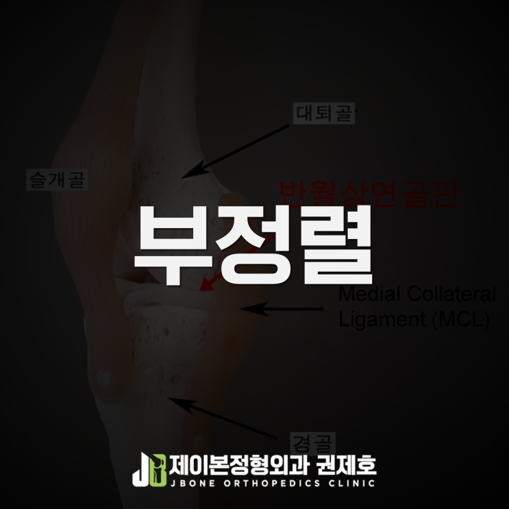 슬개골부정렬 maltracking으로 인한 무릎앞통증 / 제이본정형외과 권제호