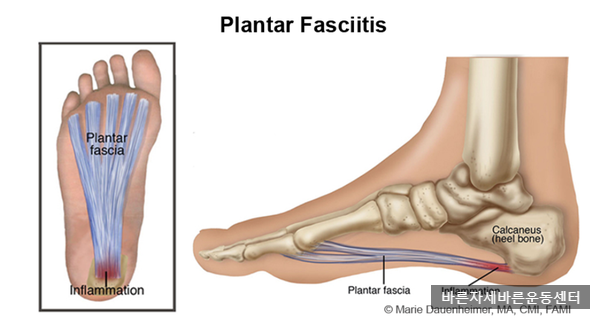[서래마을PT]발바닥 통증,발뒤꿈치 통증,족저근막염(Plantar fasciitis)이란?