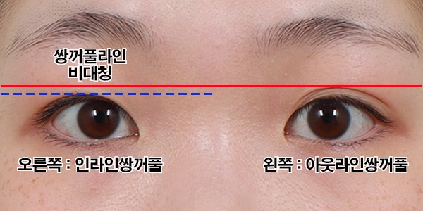 윤곽쌍꺼풀 수술을 하고 싶다면 매몰법과 절개법을 추천합니다. (신사역성형외과) 2