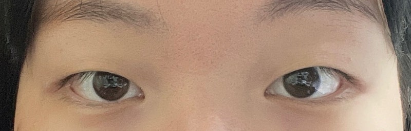 쌍꺼풀 하면 심심하지 절개+앞트임