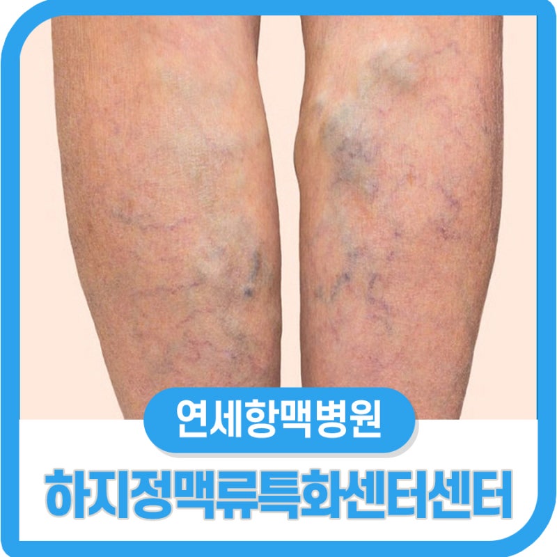 파주운정 일산정맥류 치료 및 수술 연세항마병원 파주운정 일산정맥류 치료 및 수술 연세항마병원