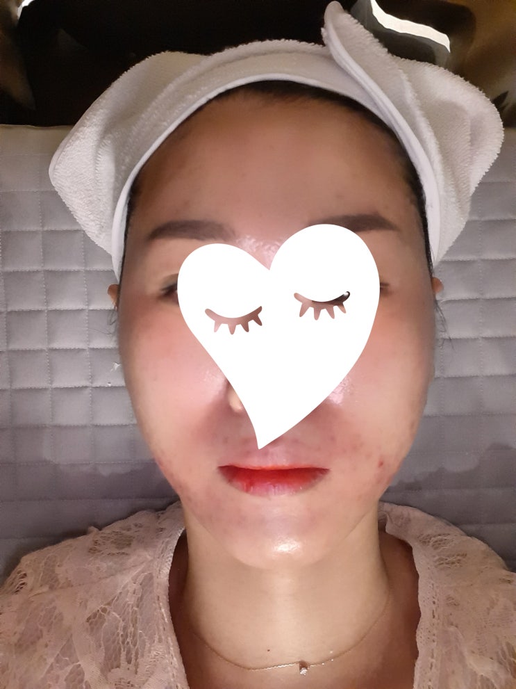  리쥬에이드 실비 스킨보톡스 키오머 차이 효과 후기