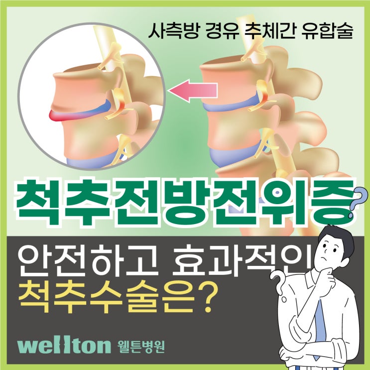  척추전방전위증, 이젠 뼈 제거 없이 안전하게 사측방 경유 척추유합술(OLIF)