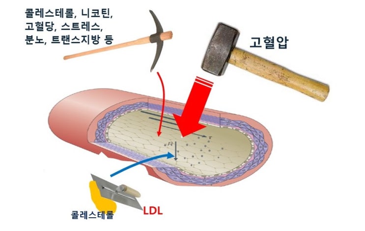 트랜스지방(trans fat)과 동맥경화증(atherosclerosis), LDL콜레스테롤, 다이어트
