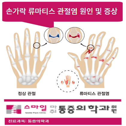  [일산손가락관절염치료] 류마티스성 손가락 관절염 VS 퇴행성 원인.증상의 차이점