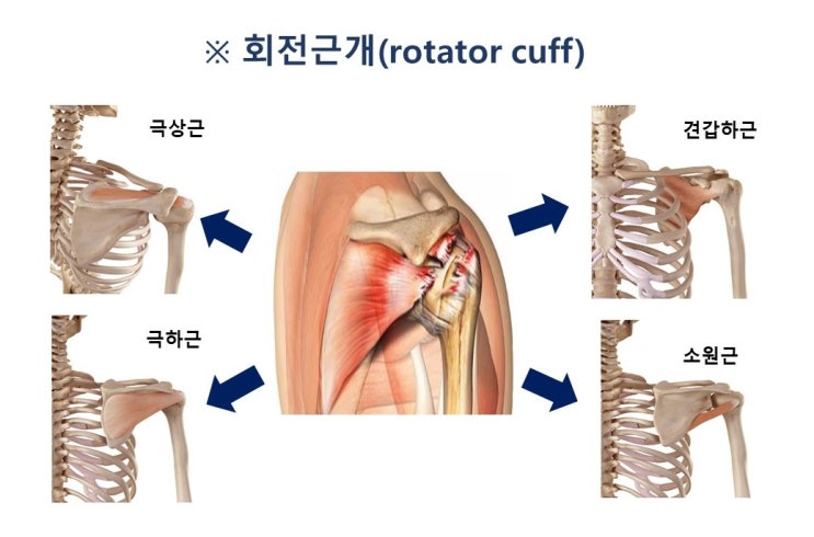  스몸비의 숙명 어깨병, 라운드숄더, 상지교차증후군, 어깨충돌증후군(shoulder impingement syndrome)