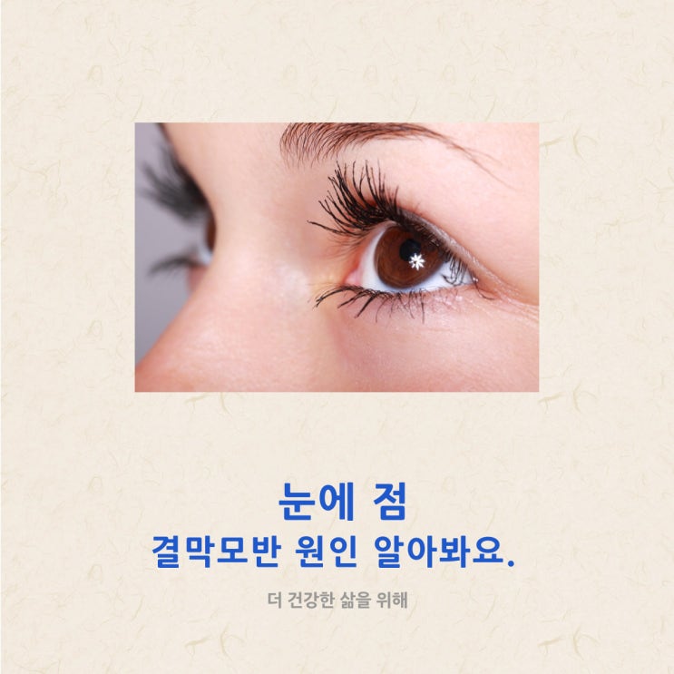 눈에 점 결막모반 원인 알아봐요.