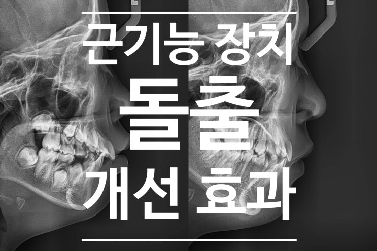 근기능장치를 통해 발치 없이 발치교정 효과를 내보자(프리올소, EF line)