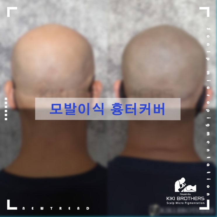  머리 흉터 커버, 놔두지 말고 커버하세요. 탈모커버, 흉터커버 전문점 키키브라더스 노원
